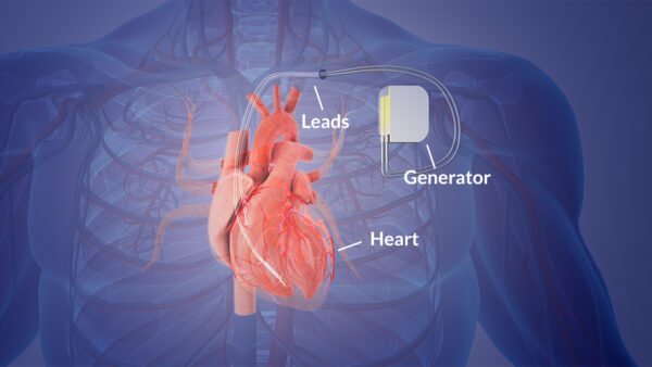 Imh Case Of The Week Heart Block And Its Treatment With Pacemaker Best Private Hospital In